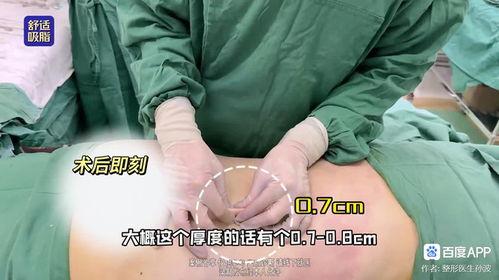 爆料桂哥抽脂视频大全图片,惊心动魄的瘦身之旅